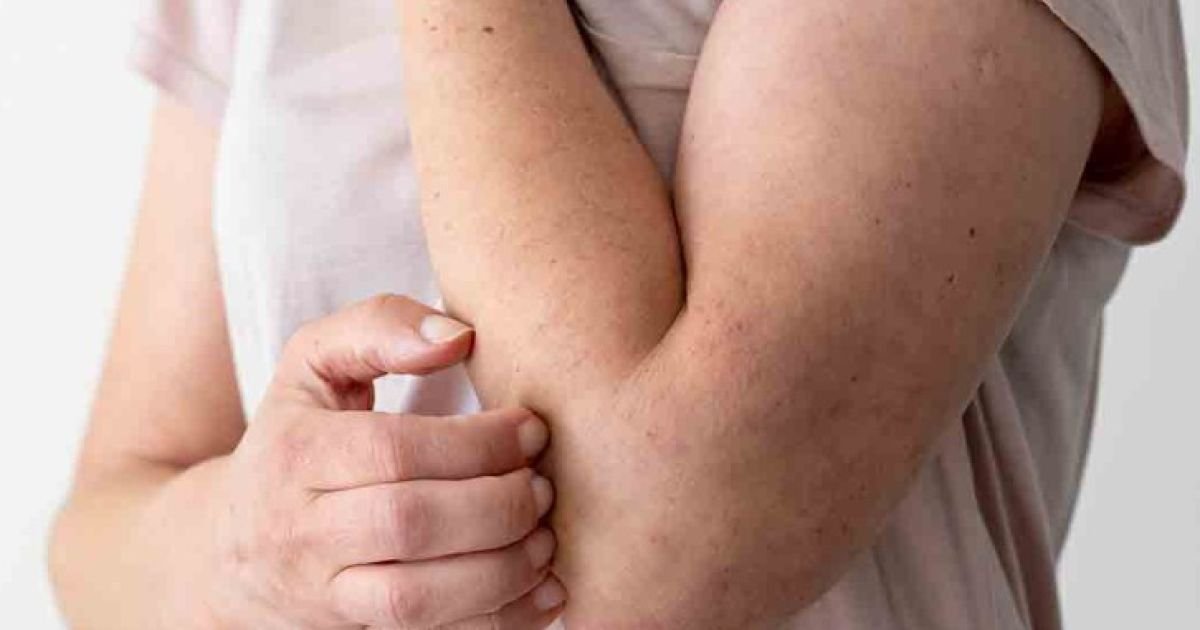 Waspada Anafilaksis! Kenali Tingkat Keparahan Alergi Udang