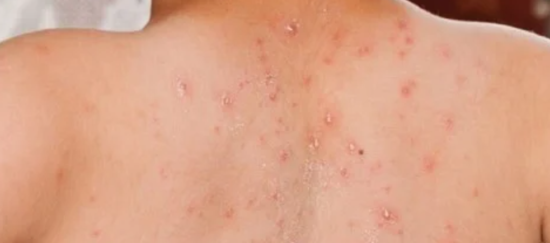 Tasikmalaya Darurat Kesehatan: Pemerintah Resmi Tetapkan Status KLB Imbas Lonjakan Kasus Campak